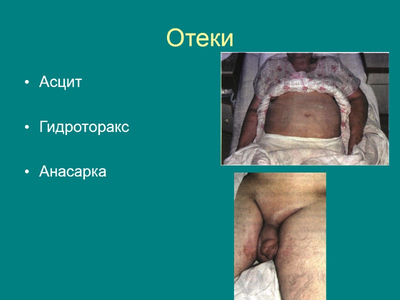 Отеки  Асцит  Гидроторакс  Анасарка